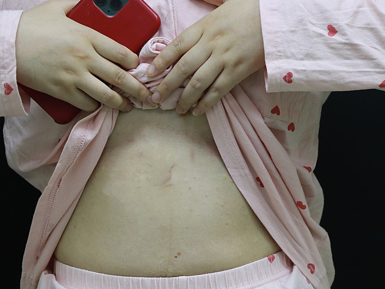 宫腹腔镜手术疤痕照片图片