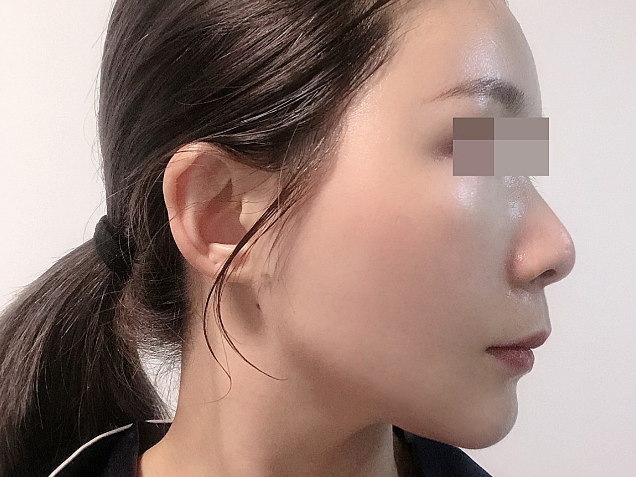 自体脂肪填充面部 面部吸脂光纤溶脂瘦脸下颌缘,苹果肌,面颊,手术医院