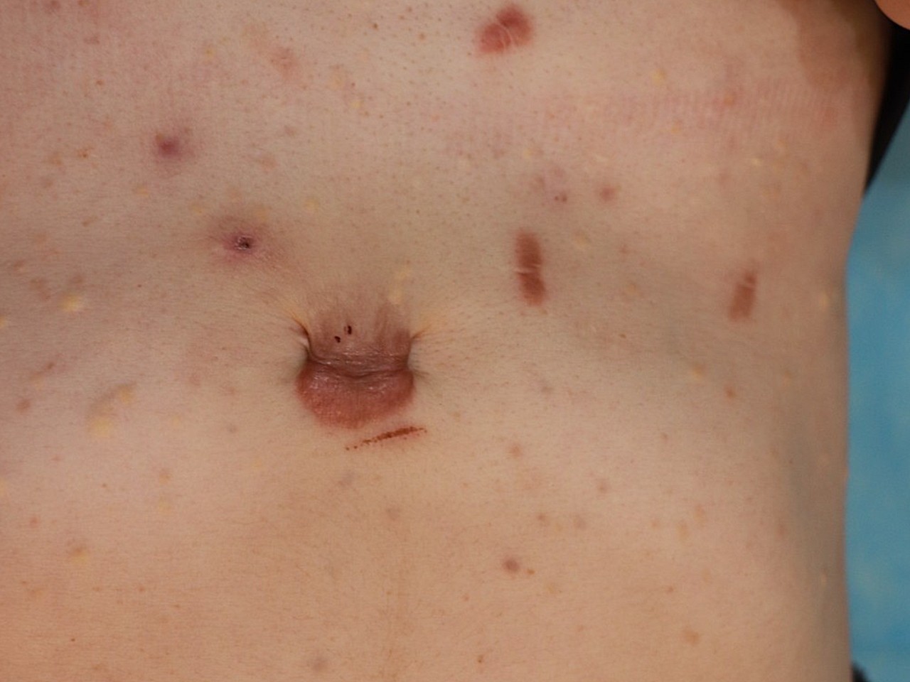 腹腔镜疤痕图图片