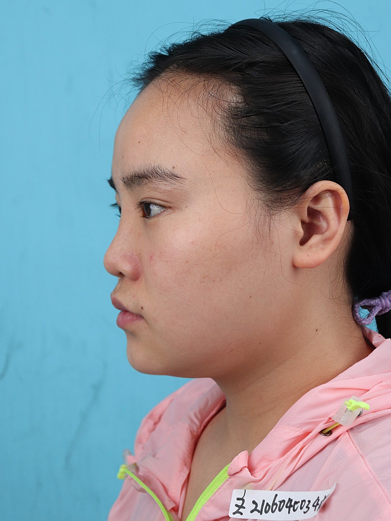 术前诊断这位女性朋友自身的鼻子比较扁平,短鼻,没有_圈子-新氧美容