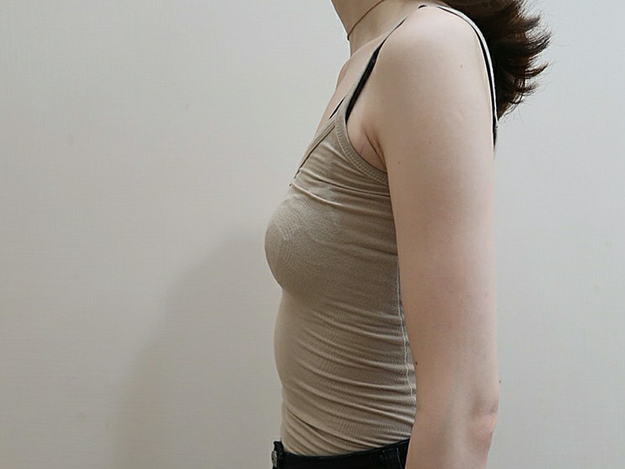 之前做过脂肪丰胸,现在是两边的下皱襞高低不一样,大_圈子-新氧美容