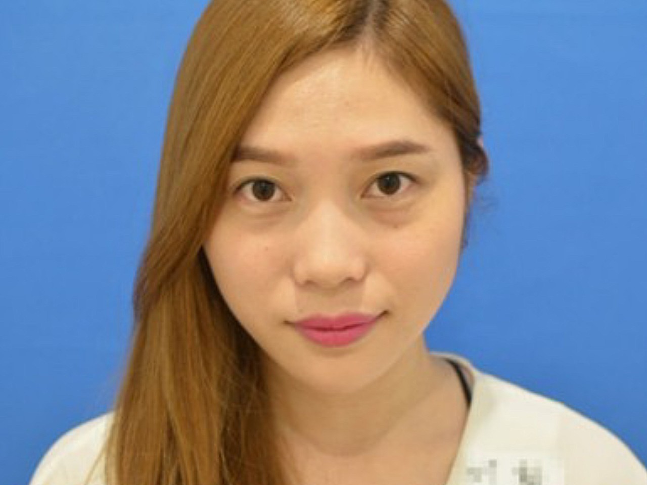 术前诊断术前眼袋明显,_圈子-新氧美容整形