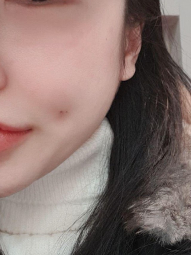 酒窝当时特地要求坐在脸颊两颗痣那儿,感觉还挺有个性_圈子-新氧美容