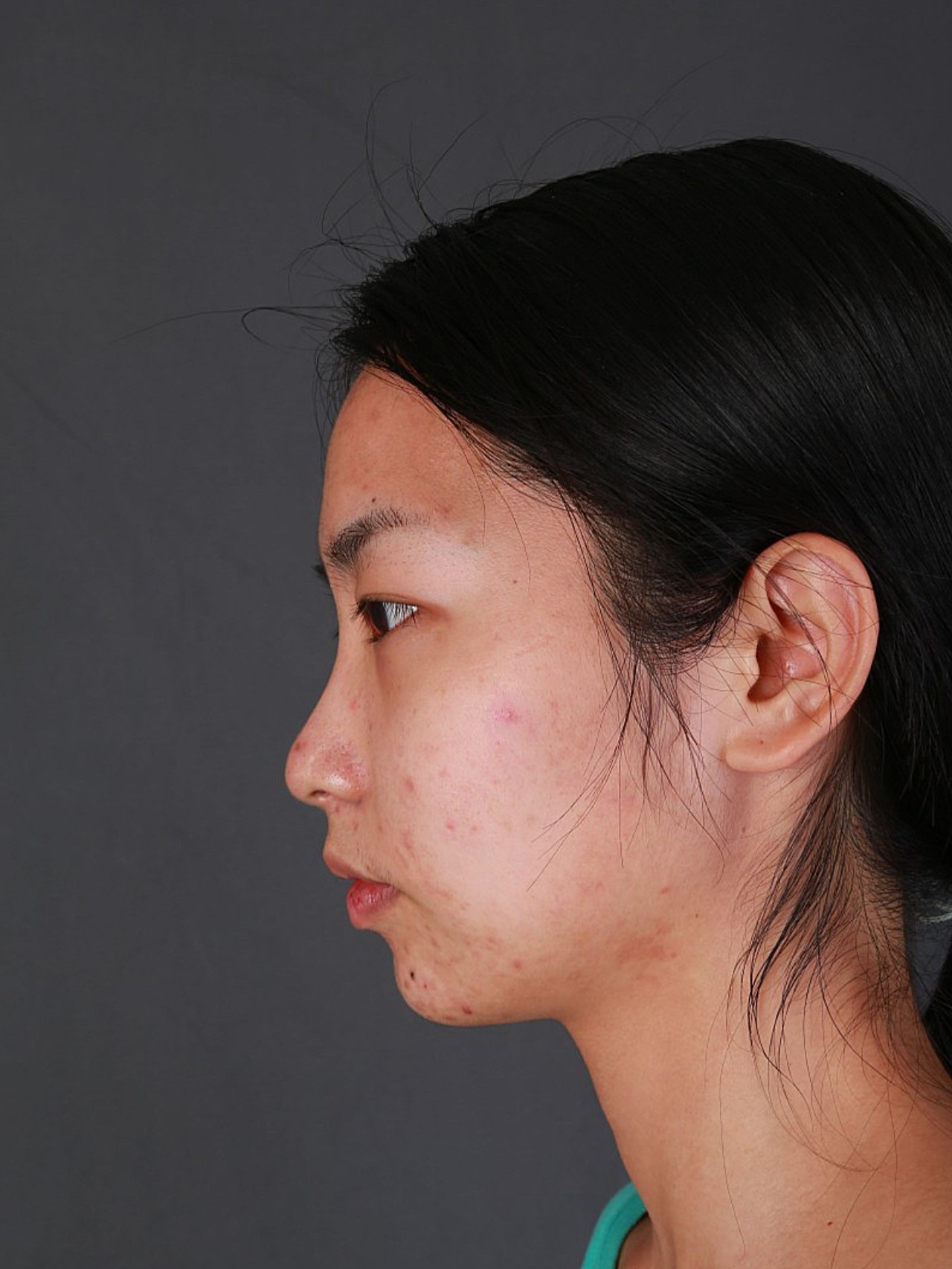 术前诊断术前患者小姐姐山根低平,鼻梁弧度不好,整