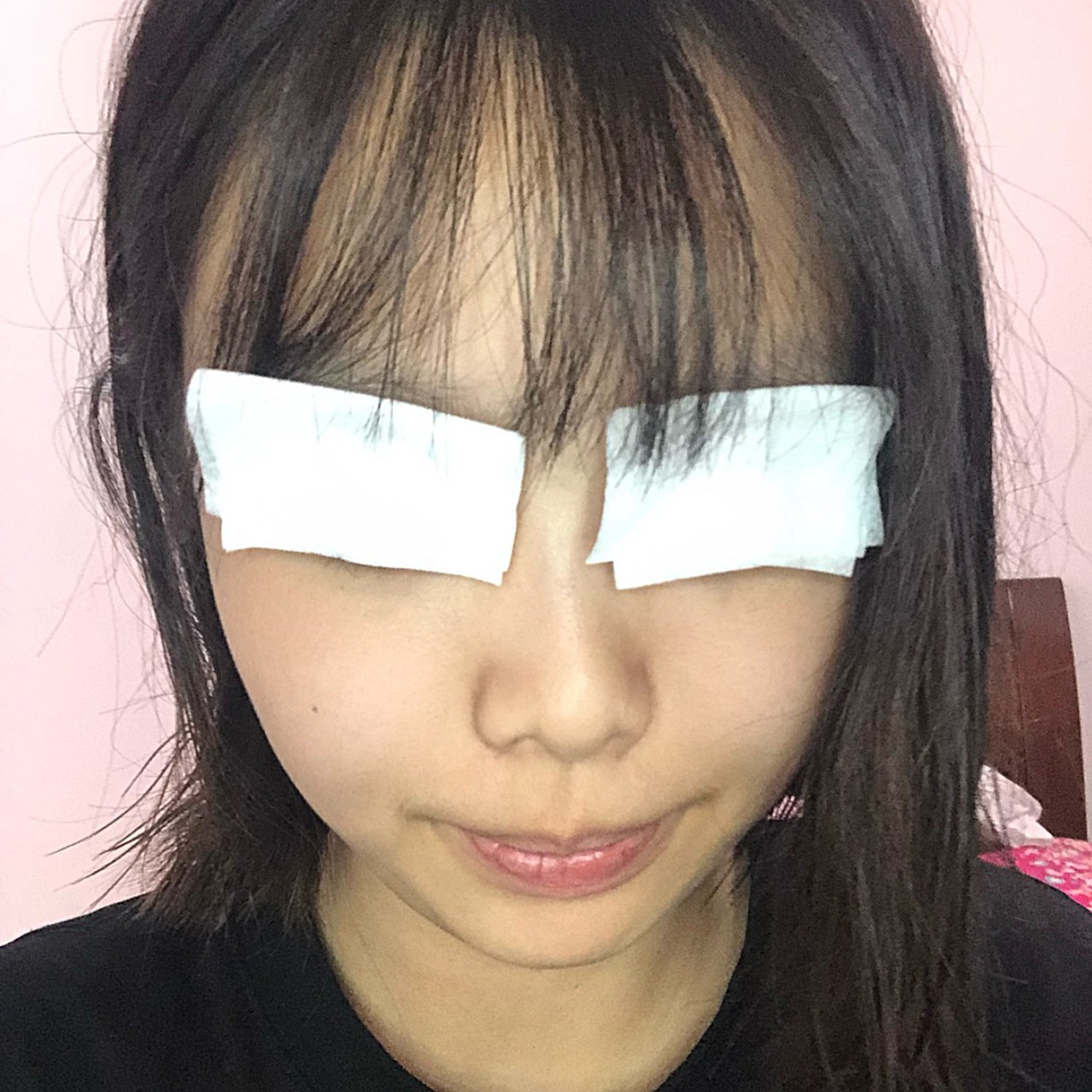 刚做完的时候纱布蒙着我的眼睛,还是挺紧张的,害怕做_圈子-新氧美容