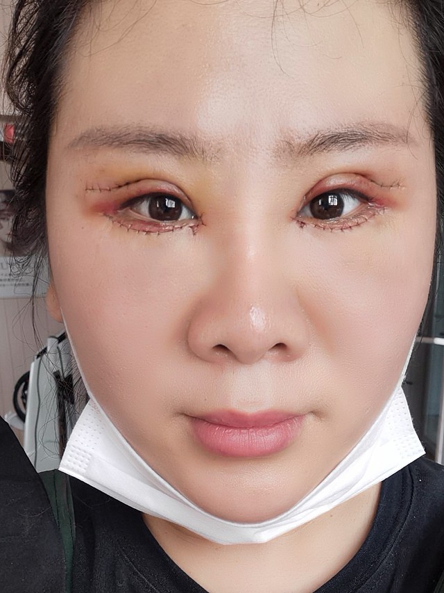 今天做双眼皮得第2天.把眼上纱布给去了.