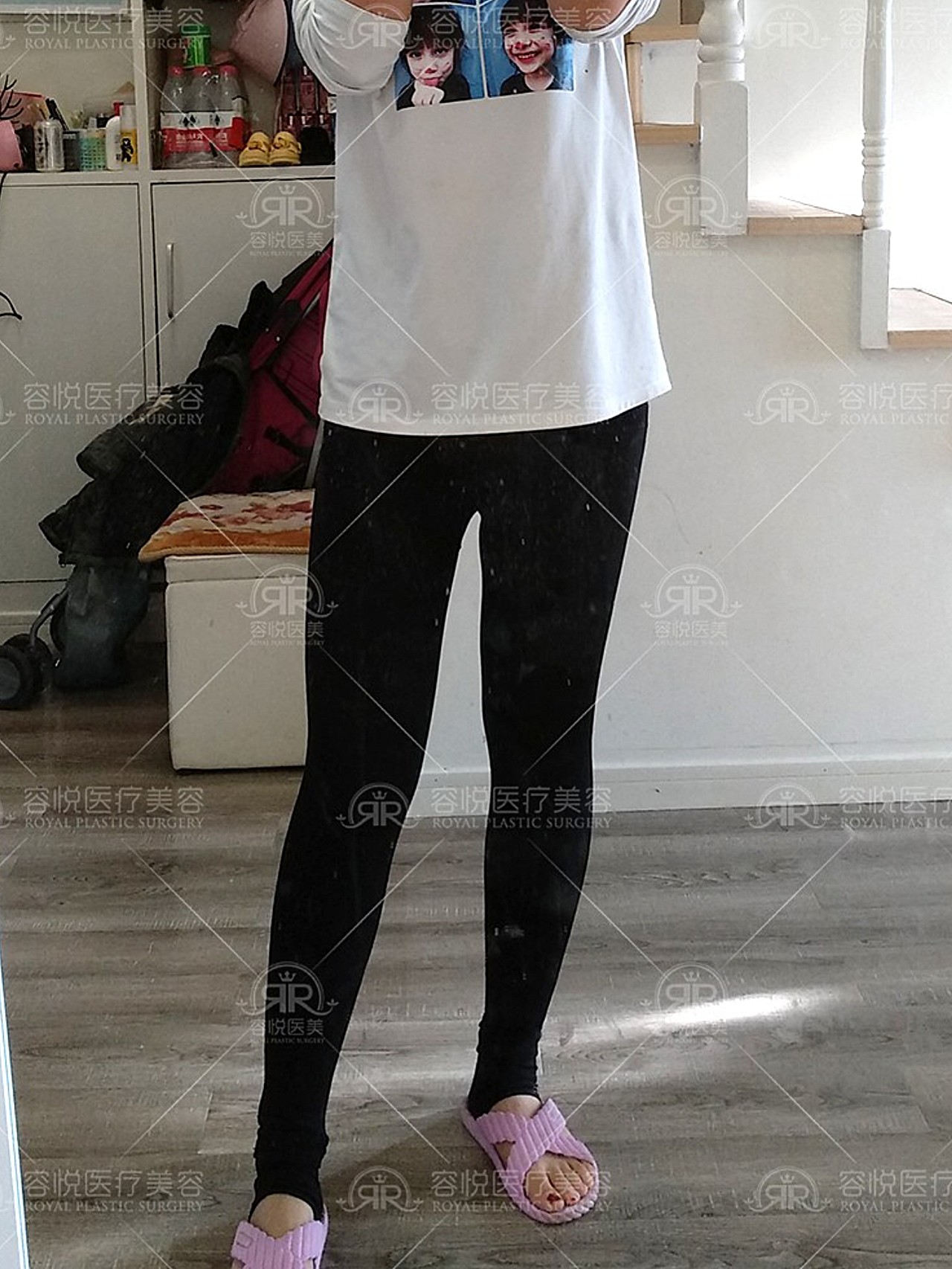 术前诊断大腿外侧脂肪堆积,粗壮厚实;腰腹脂肪隆起"_圈子-新氧美容