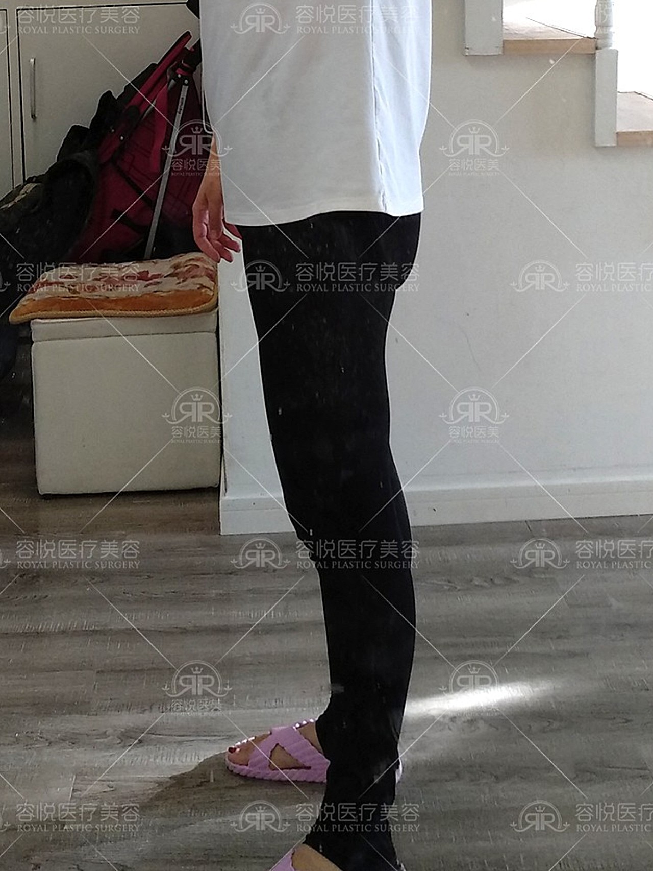 术前诊断大腿外侧脂肪堆积,粗壮厚实;腰腹脂肪隆起"_圈子-新氧美容