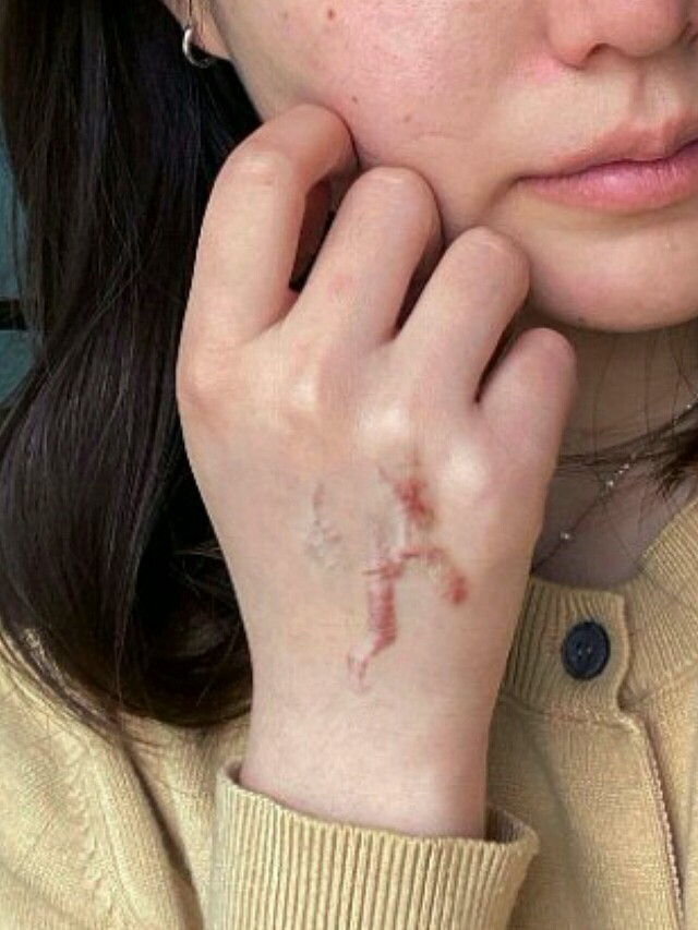 女孩子手上伤疤图片图片