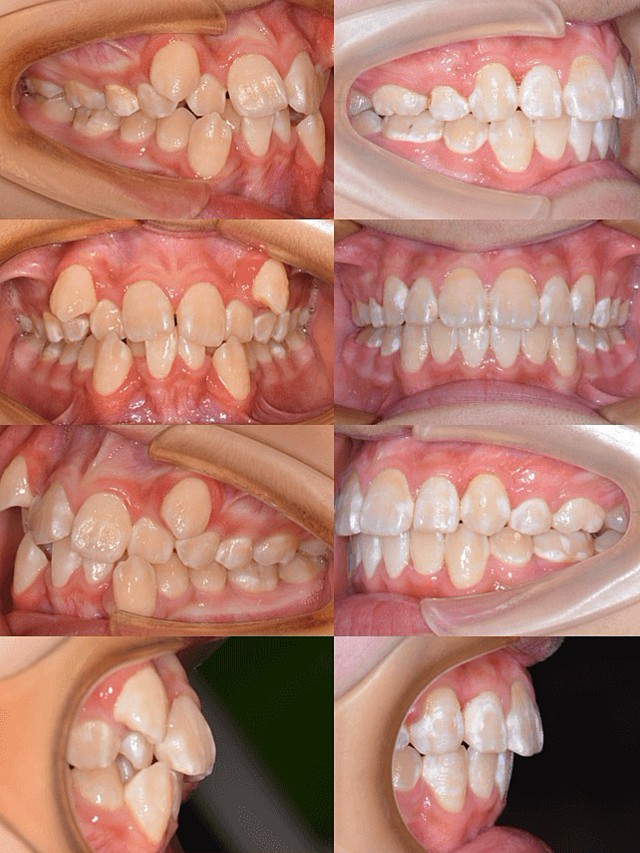 今天給大家分享的是一位13歲的小男孩因為牙齒嚴重擁擠牙列不齊來做
