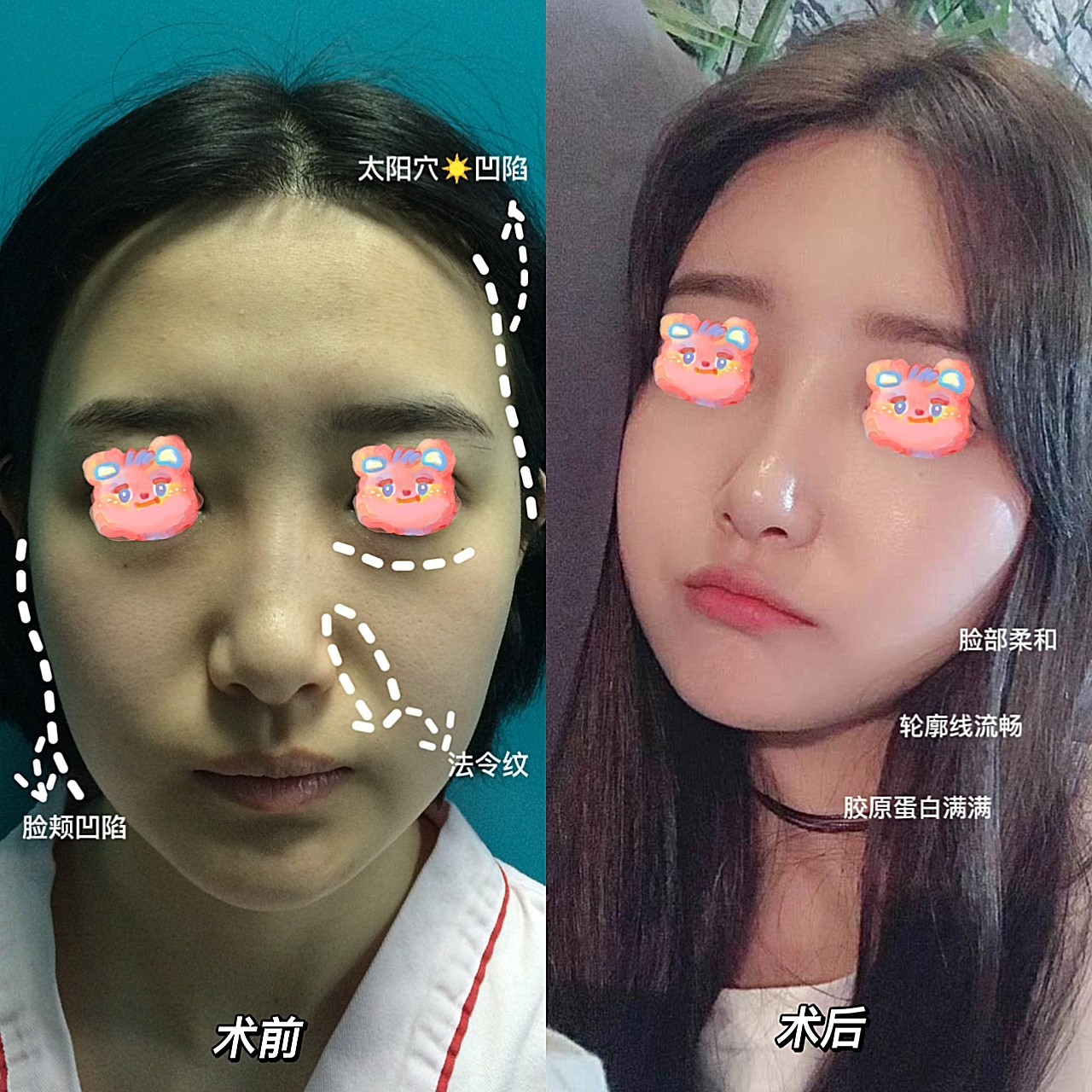 体验前变美诉求:总感觉脸部的轮廓不好看的,而且我脸颊的地方有个明显