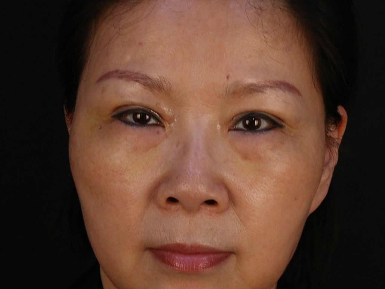 年龄不是阻碍时尚大妈来做了双眼皮