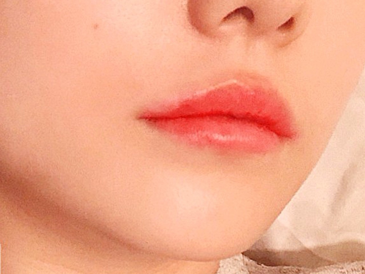 体验前变美诉求:上嘴唇比较厚,形状一点也不好看,下嘴唇也一点都不够