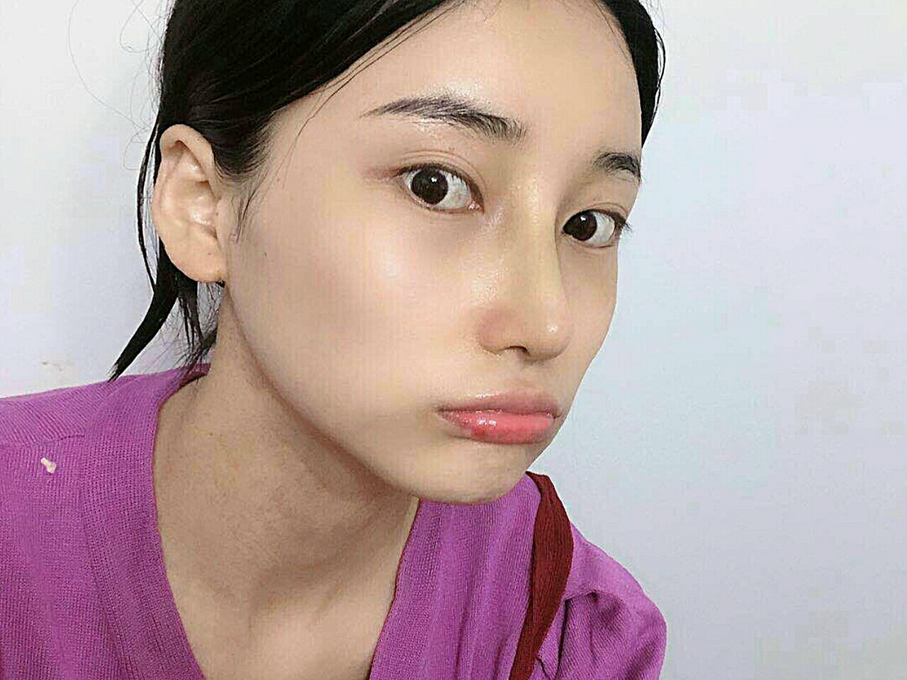 体验前变美诉求:鼻梁矮,山根低平,鼻头圆钝,有驼峰不平滑