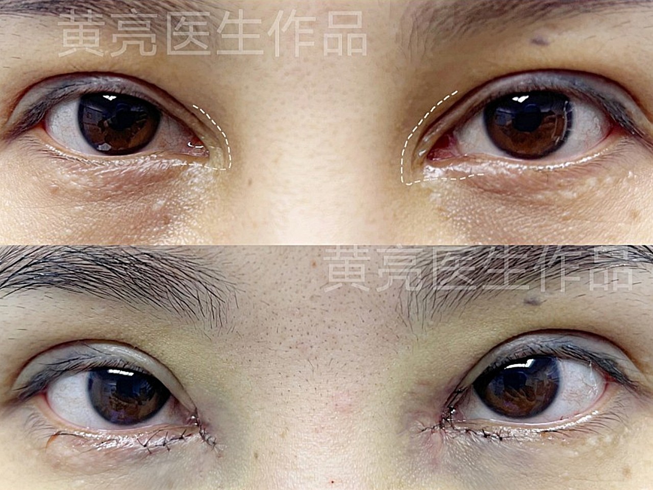 dr黄亮内眼角过大微创修复案例