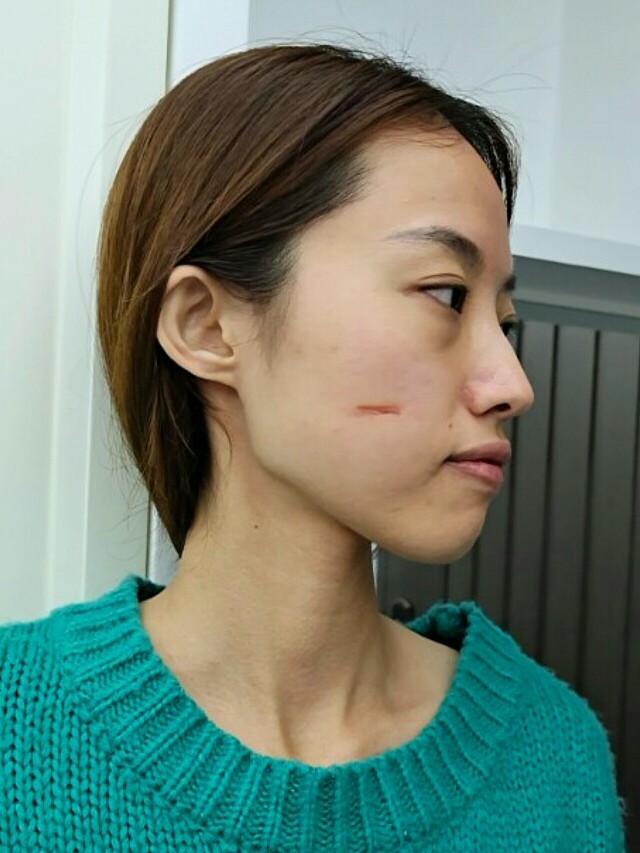 在清沁做祛疤项目也有几个月的时间了,现在疤痕凹陷的地方已经恢复的