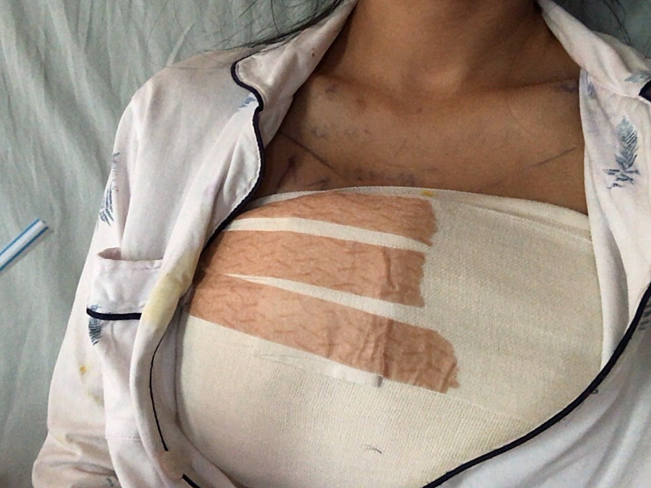 术后第一天,胸部涨得很,有一点点疼,但忍忍还是可以_圈子-新氧美容