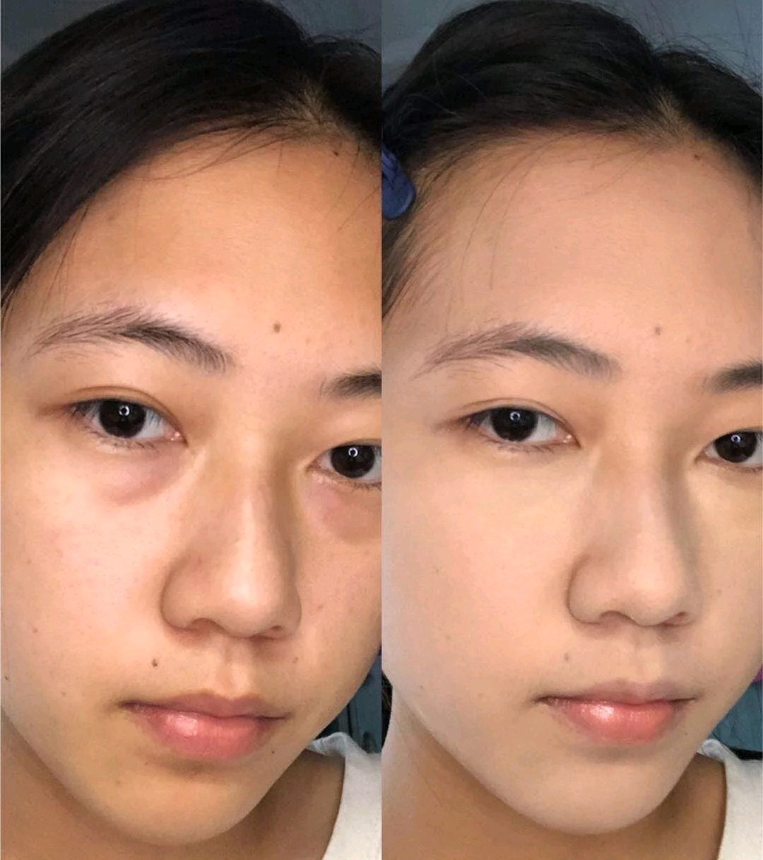 女生眼袋很重怎么解决