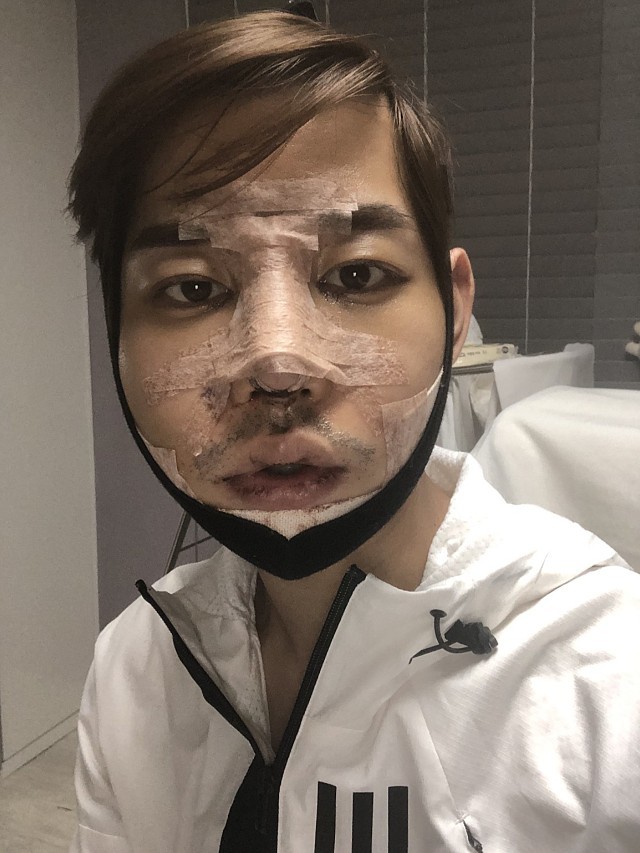 6月热议榜一个月了,最舒服的就是鼻子绷带拆了,三_圈子-新氧美容整形