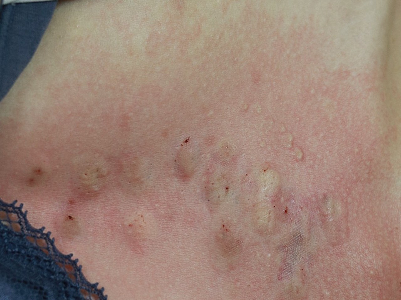 我胸前这疤痕有5年了,是长痘痘引起的,有时候还会痒