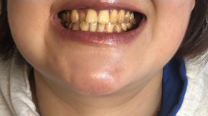 一直很羡慕明星拥有一口超洁白整齐的牙齿.