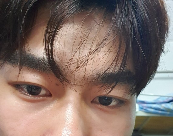 泪沟 我这样的泪沟算严重吗,需不需要填充,需要的话,胶原蛋白