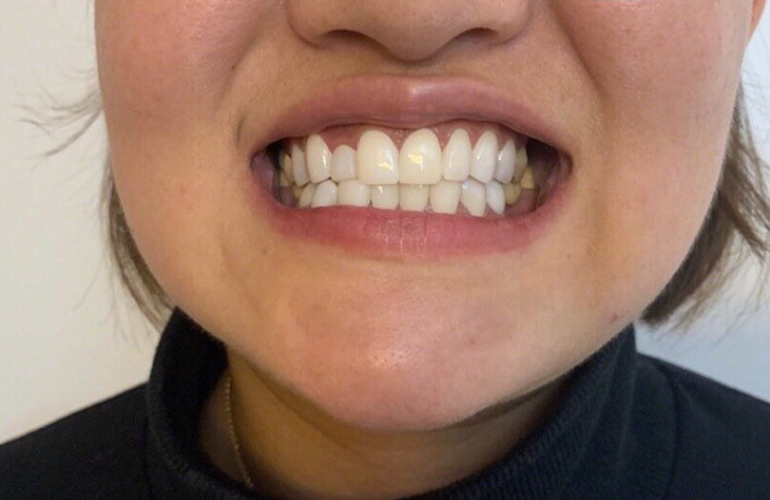 一直很羡慕明星拥有一口超洁白整齐的牙齿.