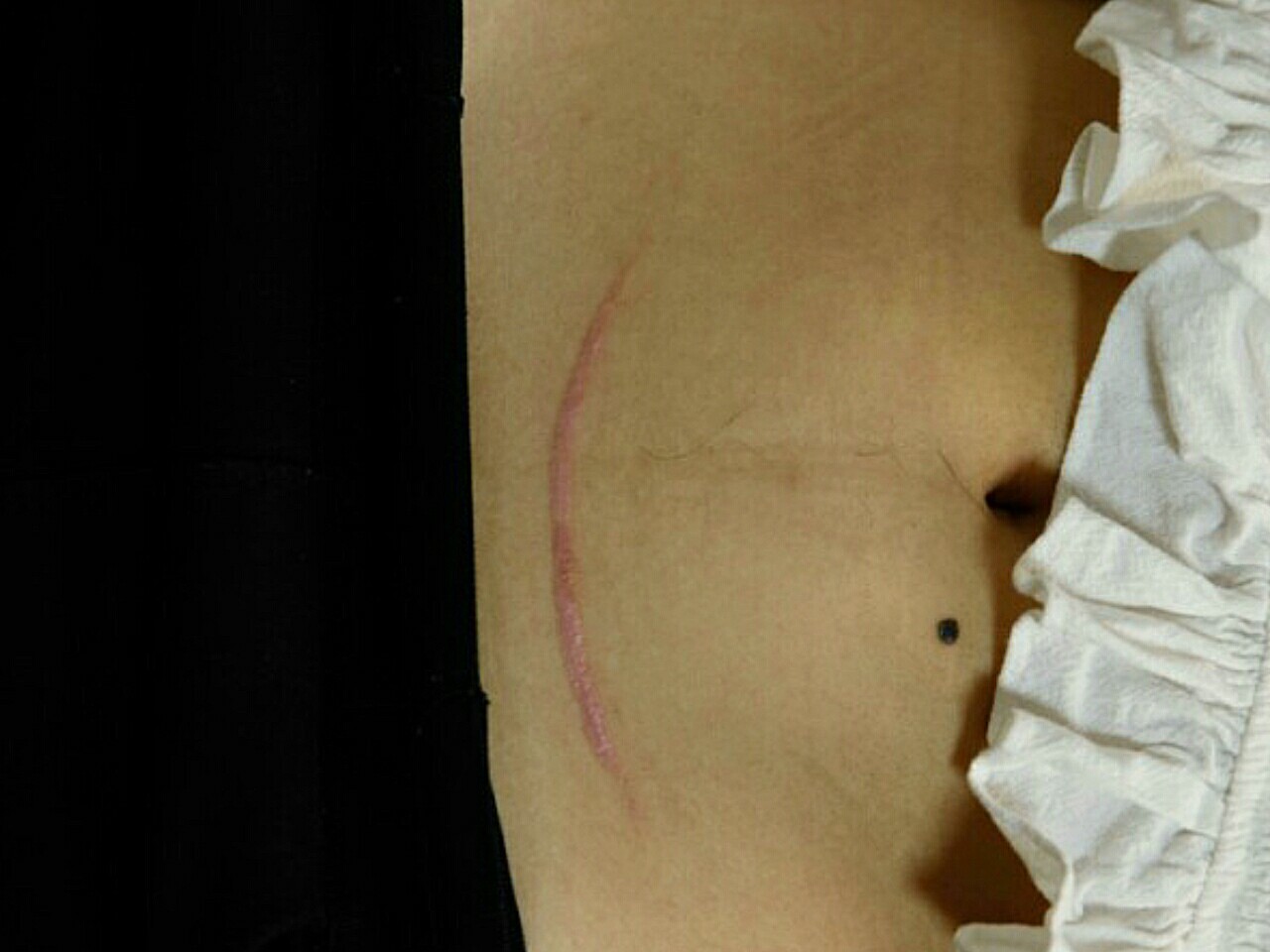 已经去医院治疗2次了,目前疤痕增生凸起的部分已经平了很多