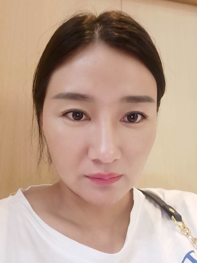 法令纹填充前后对比效果很满意