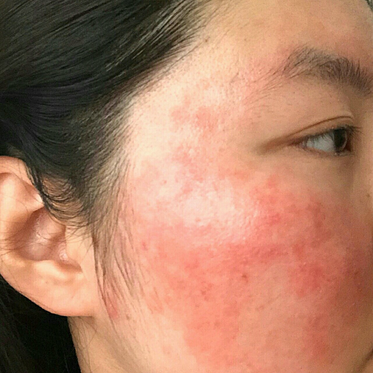 [项目]光子嫩肤,祛红血丝之前在丽都买了m22的年_圈子-新氧美容整形