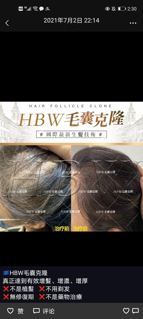 大家知道联合丽格第二医院的hbw毛囊克隆技术吗?有_圈子-新氧美容整形