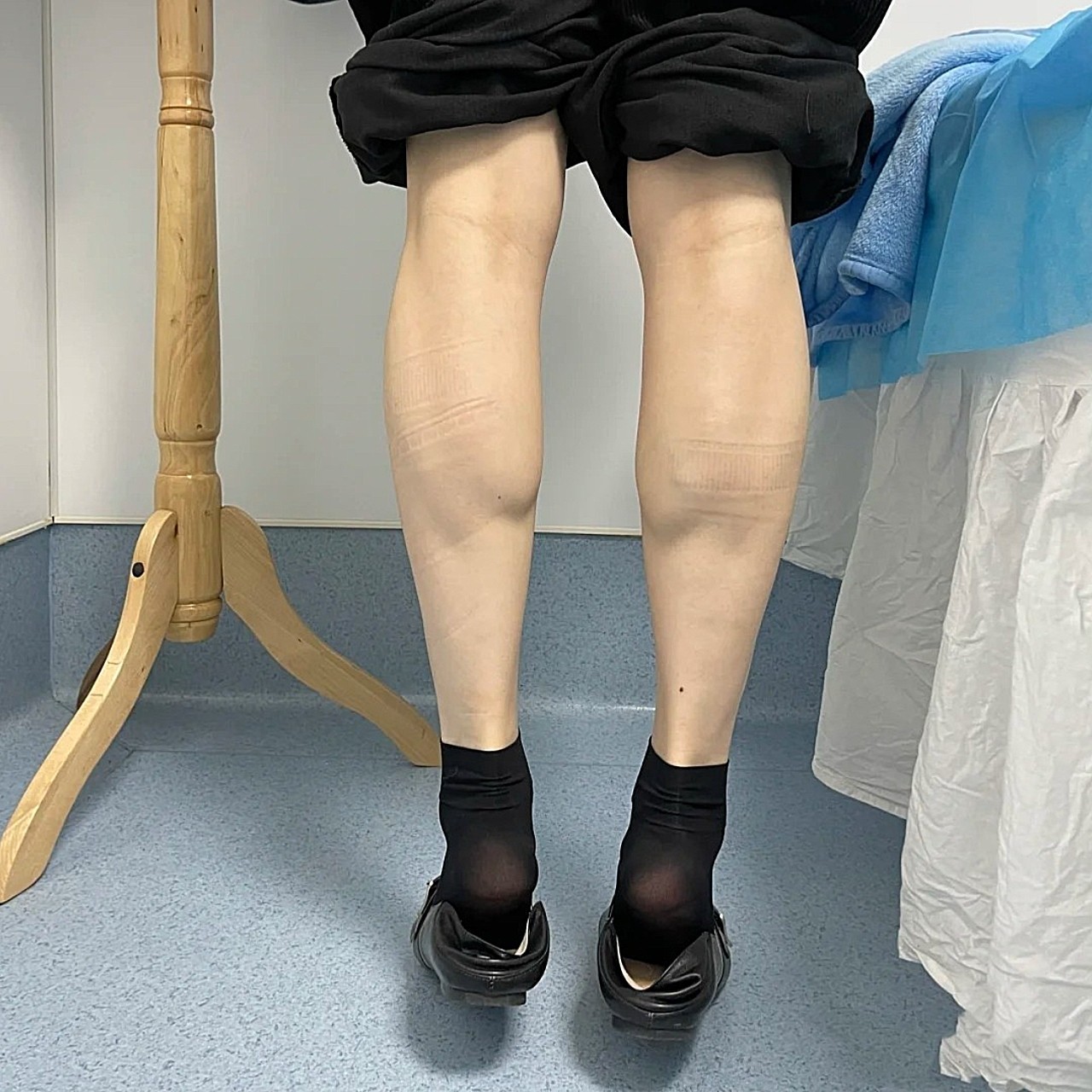 因为小腿肌肉发达看起来特别奇怪,第一次注射之后觉得