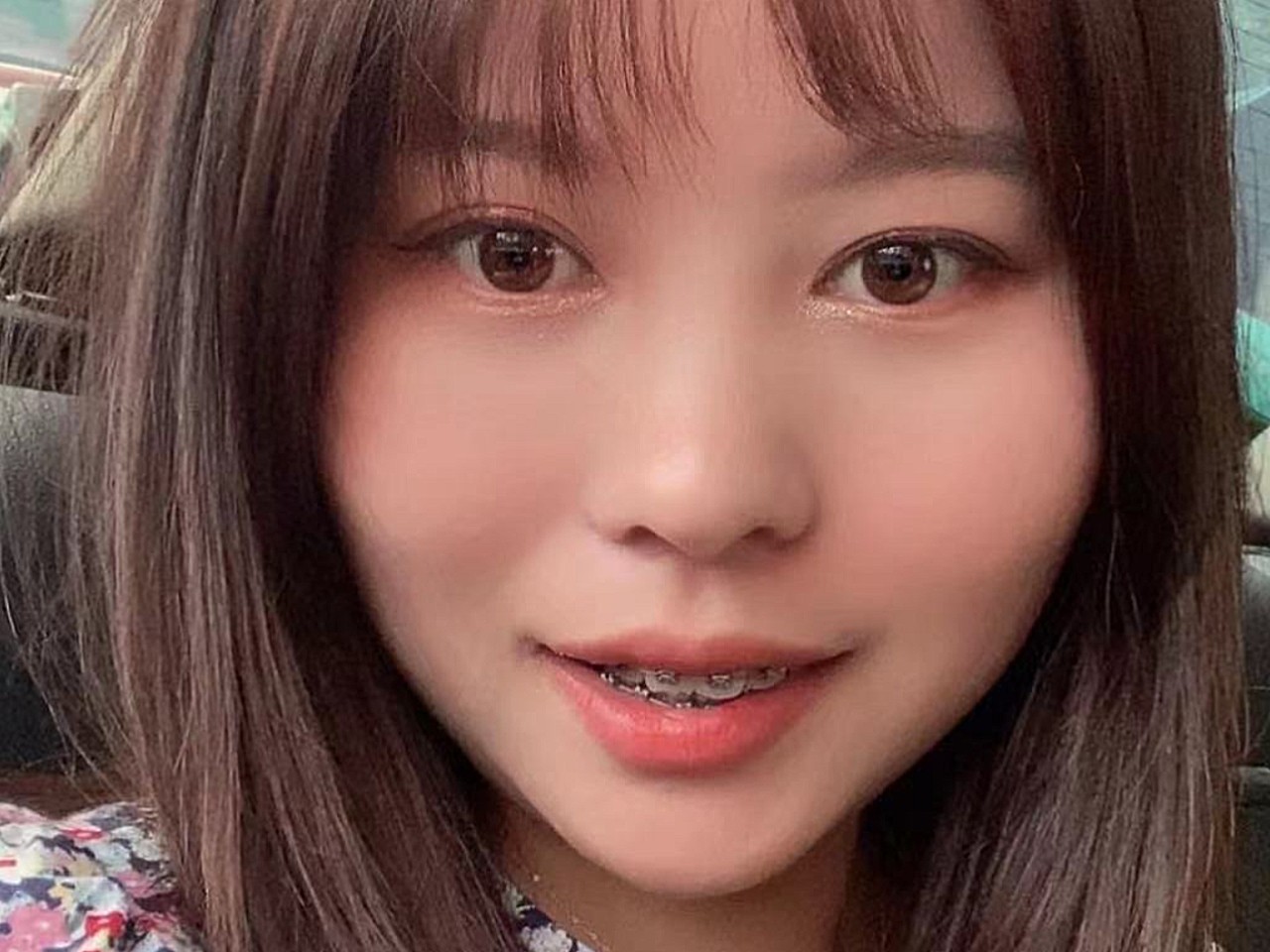 今天牙齿矫正结束了,好高兴,牙齿整整齐齐的,白白净_圈子-新氧美容