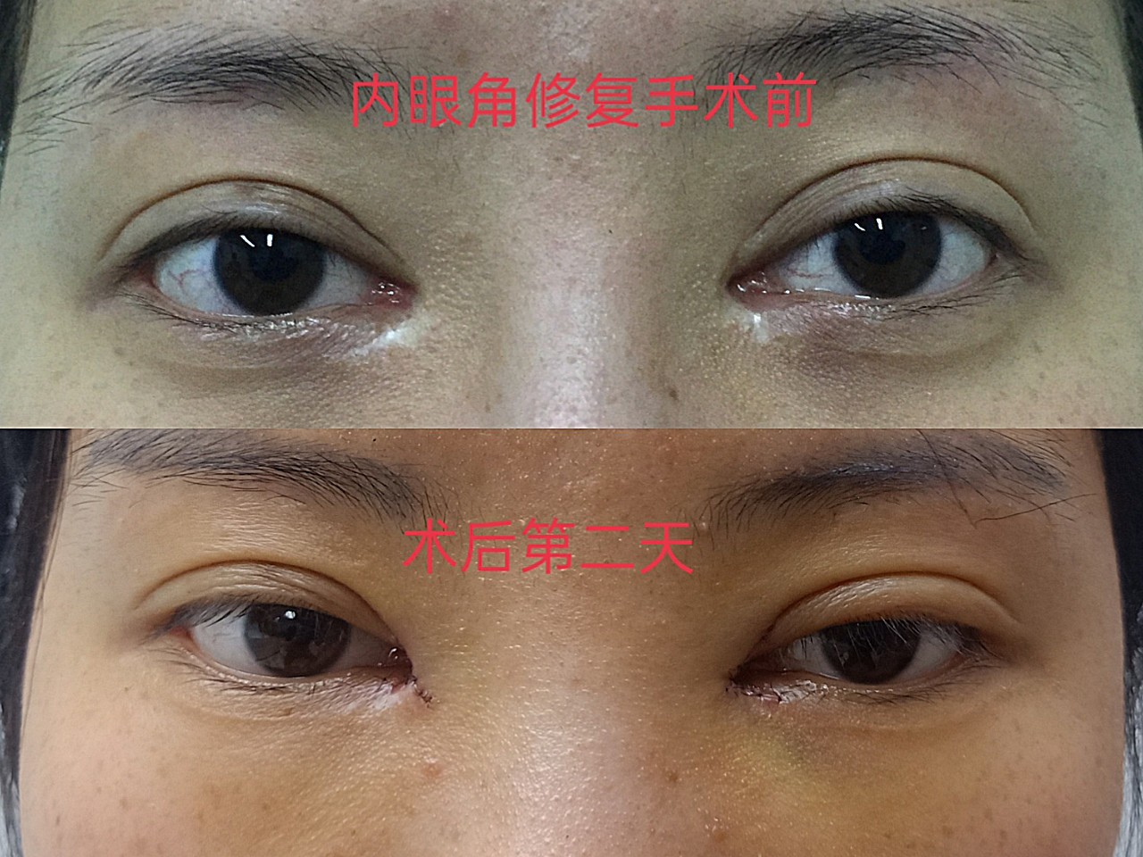 内眼角开大了,疤痕重,长魏院长给她把疤痕修复,回包_圈子-新氧美容