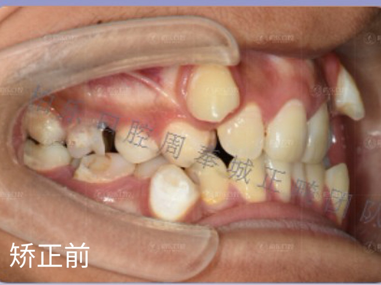 重叠牙不拔后果图片