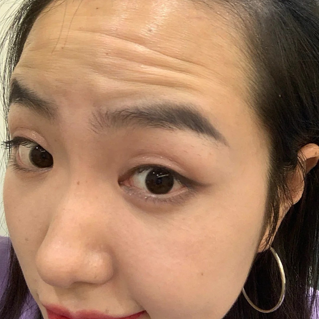 天生抬头纹严重,打了有效果的奥,医生很专业棒棒哒环_圈子-新氧美容