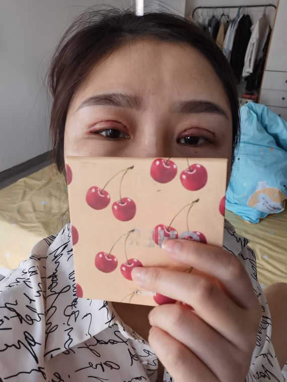 双眼皮全切第二天,昨天下午一点做的手术,整个过程不_圈子-新氧美容