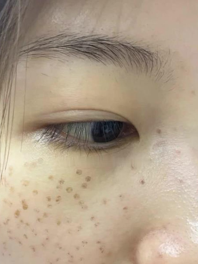 我的斑基本以雀斑晒斑为主,主要在面部中庭,眼下方还有鼻子上都有,密