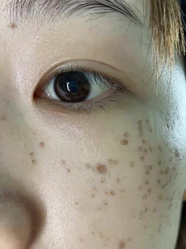 我的斑基本以雀斑晒斑为主,主要在面部中庭,眼下方还有鼻子上都有,密