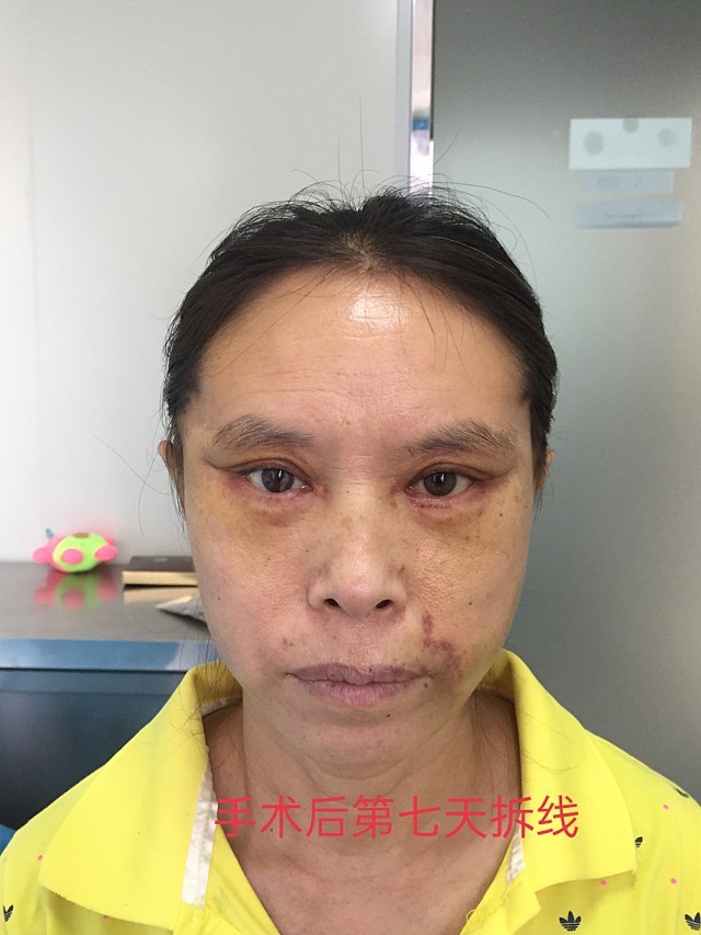 48歲天津大姐之前做了去眼袋眼瞼外翻厲害,還經常留眼淚,諮詢很多家