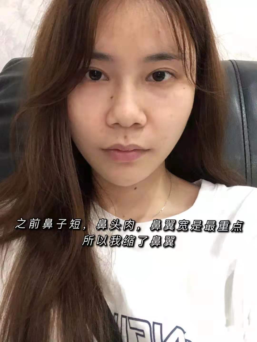 我的鼻子的问题是鼻子比较短,鼻头肥大不够精致,鼻尖_圈子-新氧美容