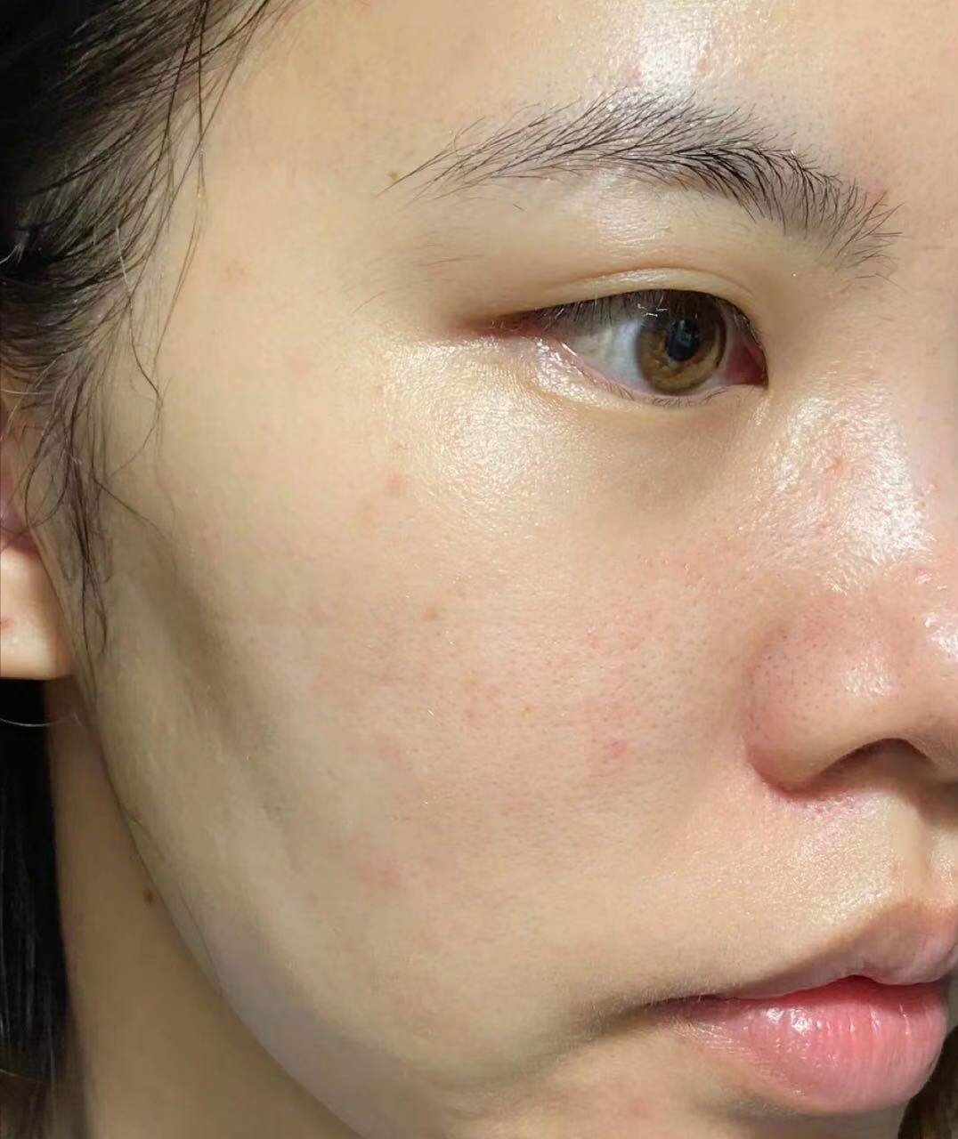 术前法令纹明显下颌缘不清晰眼周细纹松弛