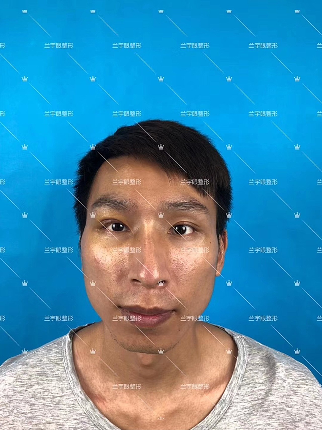 术前诊断左右眼部不对称,左眼属于重度上睑下垂,瞳孔_圈子-新氧美容