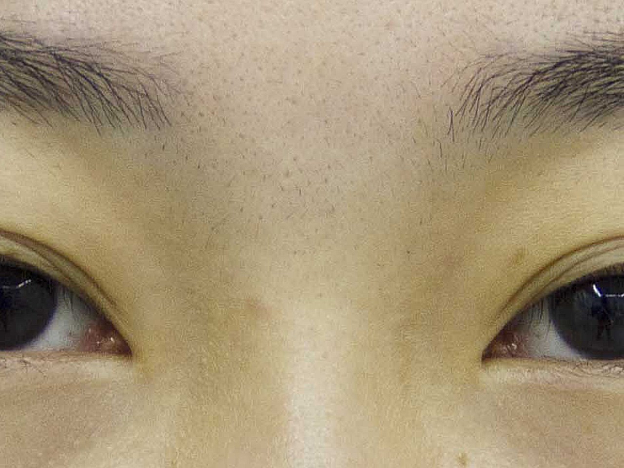 想做双眼皮很久了,我的眼睛有点松弛,三层眼,特别显_圈子-新氧美容
