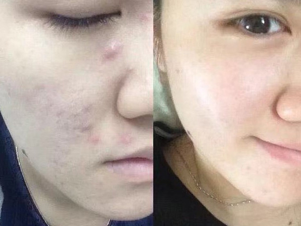 皮肤一直不稳定,自己在家刷酸弄得屏障受损.