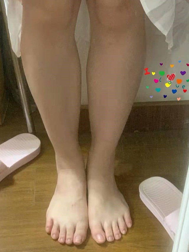 瘦腿针打完有半个月了,第一张是没有打时候小腿情况