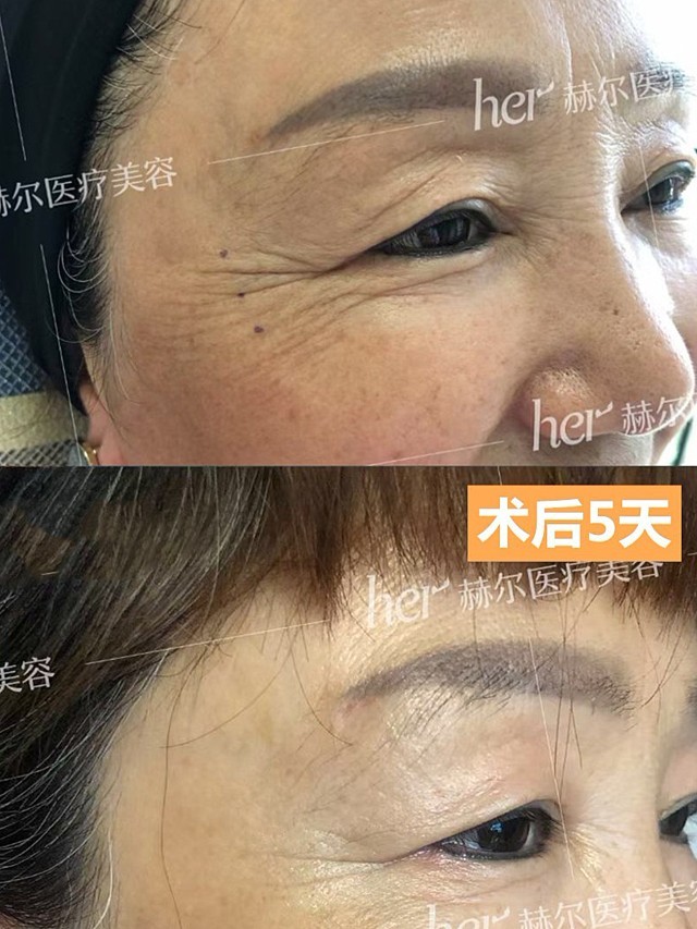 鱼尾纹注射除皱5天效果