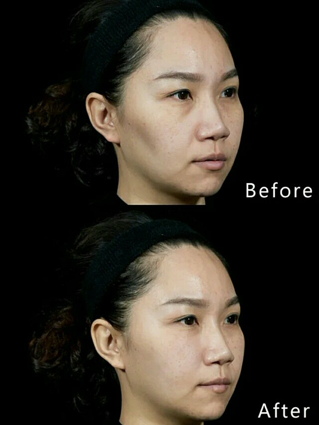 之前面颊凹陷非常显老,脸颊填_圈子-新氧美容整形