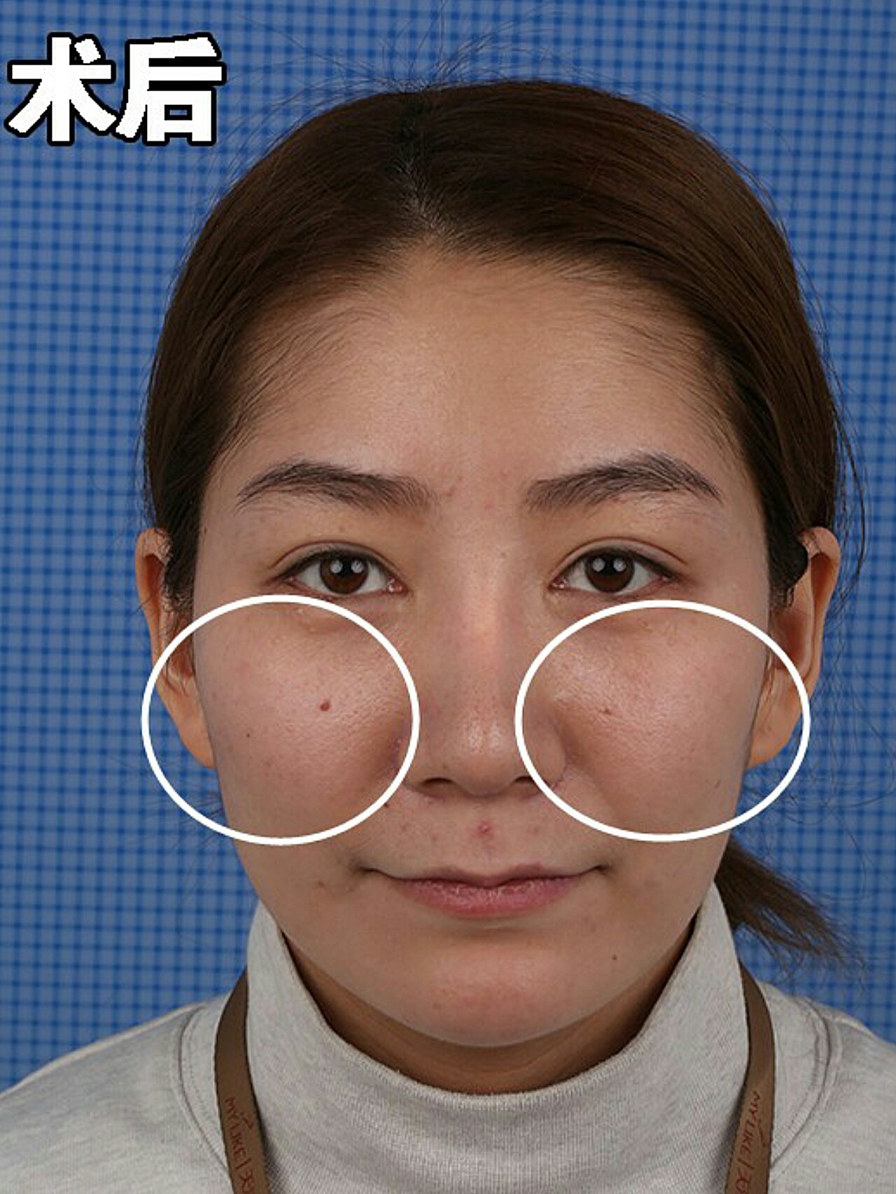 99皱纹,面部凹_圈子-新氧美容整形