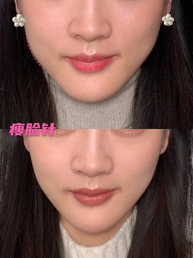 咬肌比较发达,而且两边脸仔细看还是不对称的,喜欢吃_圈子-新氧美容